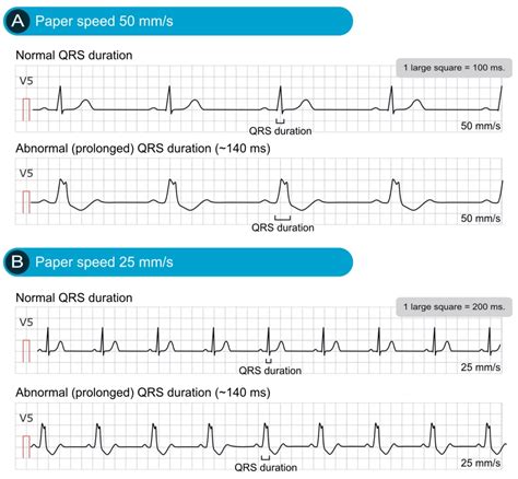 ekg readings abnormal|normal ekg reading vs abnormal.